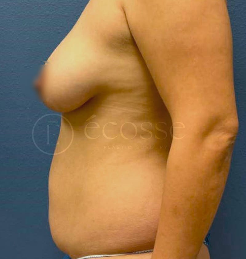 Abdominoplasty Before & After Gallery - Patient 297301 - Image 9