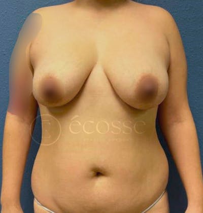 Abdominoplasty Before & After Gallery - Patient 297301 - Image 1