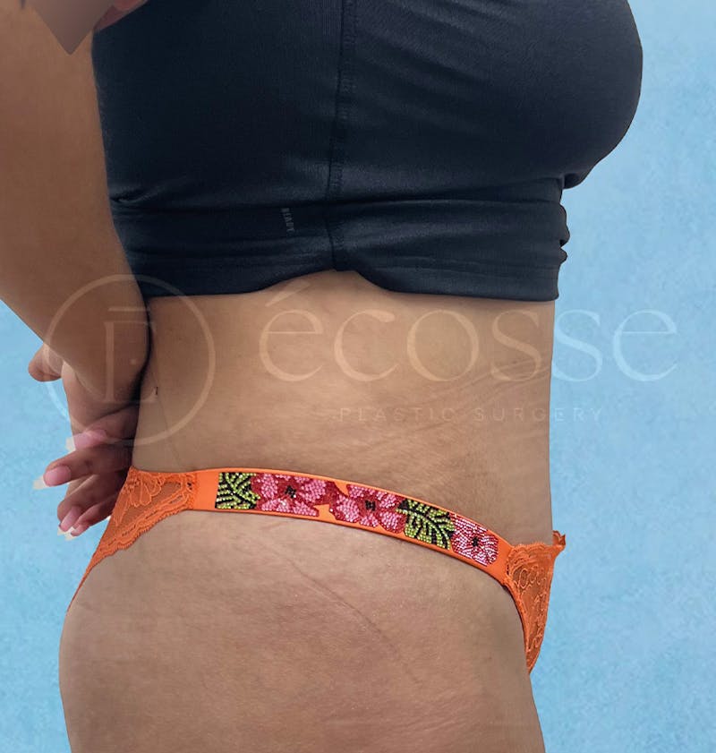 Abdominoplasty Before & After Gallery - Patient 297301 - Image 6