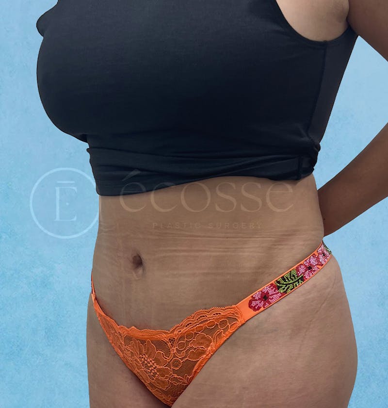 Abdominoplasty Before & After Gallery - Patient 297301 - Image 8