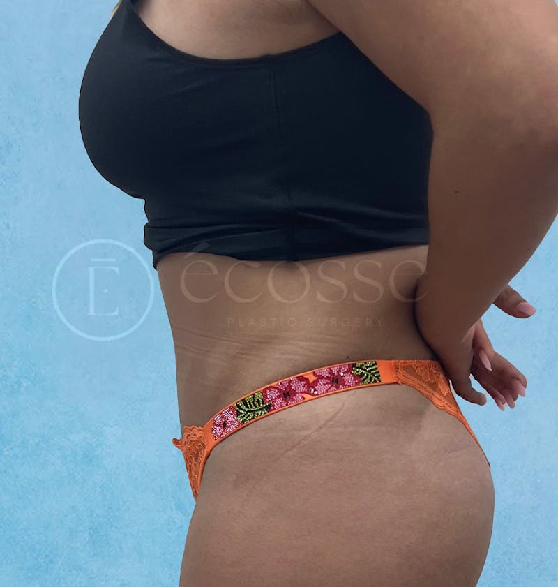 Abdominoplasty Before & After Gallery - Patient 297301 - Image 10