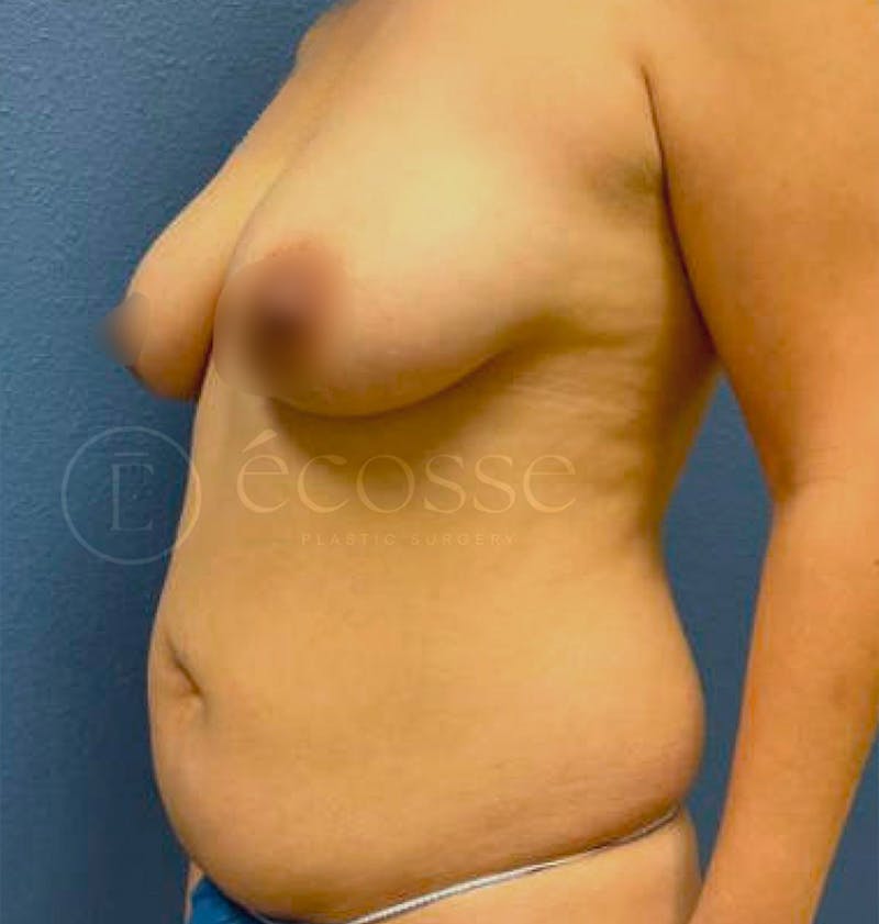 Abdominoplasty Before & After Gallery - Patient 297301 - Image 7