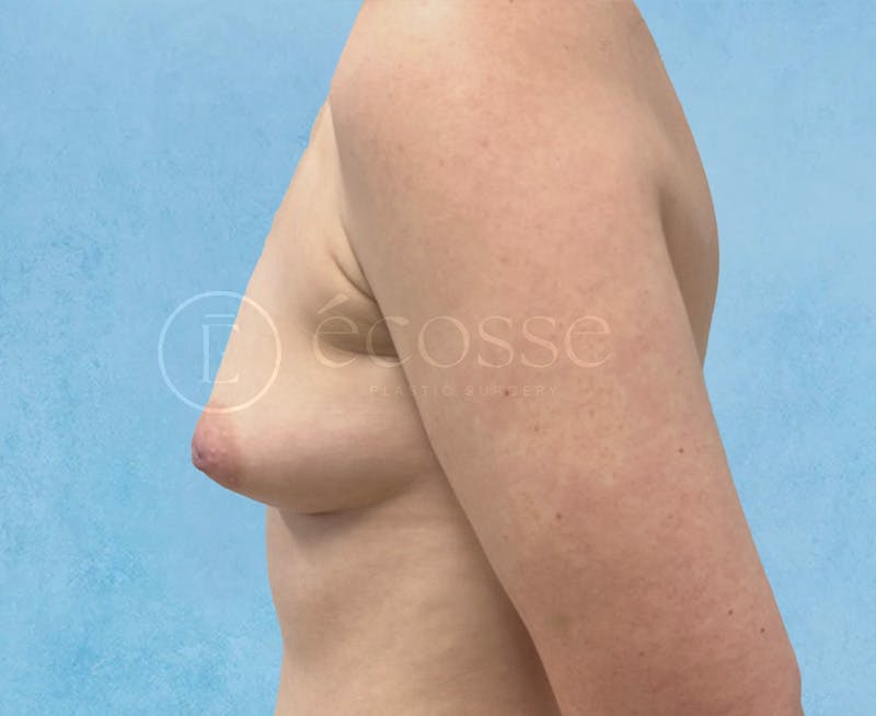 Breast Augmentation Before & After Gallery - Patient 166244 - Image 9