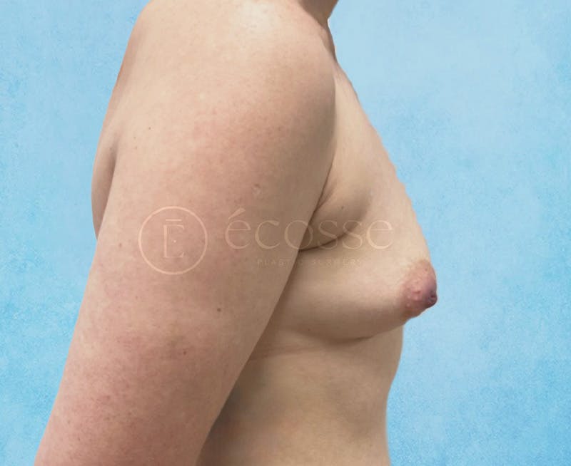 Breast Augmentation Before & After Gallery - Patient 166244 - Image 5