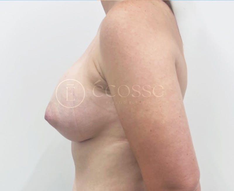 Breast Augmentation Before & After Gallery - Patient 166244 - Image 10