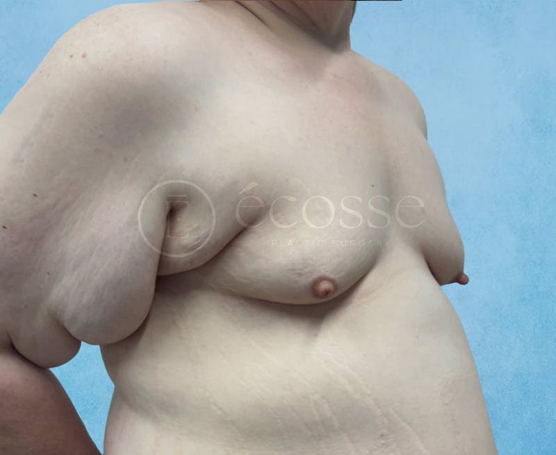 Breast Augmentation Before & After Gallery - Patient 946897 - Image 3