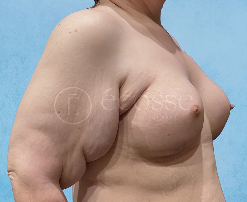 Breast Augmentation Before & After Gallery - Patient 946897 - Image 4