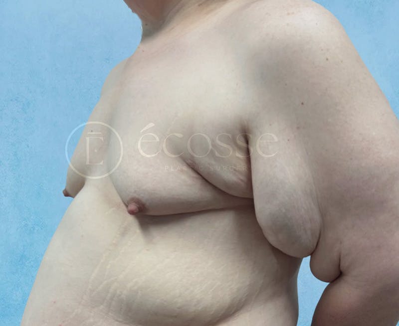 Breast Augmentation Before & After Gallery - Patient 946897 - Image 7