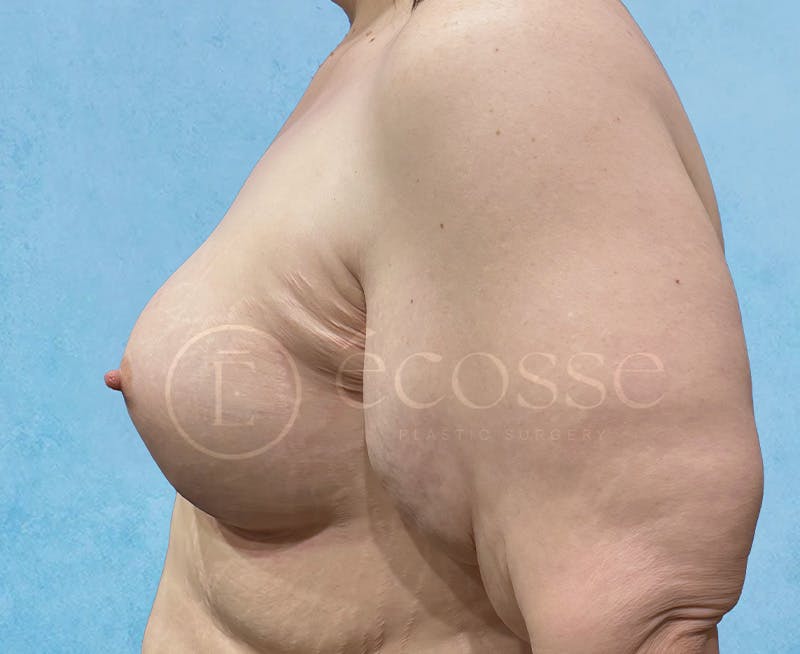 Breast Augmentation Before & After Gallery - Patient 946897 - Image 10