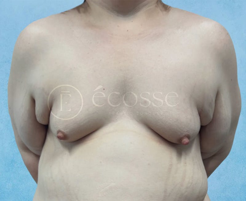 Breast Augmentation Before & After Gallery - Patient 946897 - Image 1