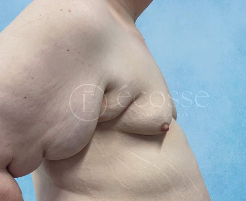 Breast Augmentation Before & After Gallery - Patient 946897 - Image 5