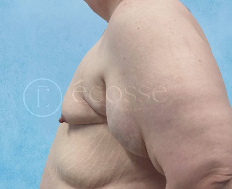 Breast Augmentation Before & After Gallery - Patient 946897 - Image 9