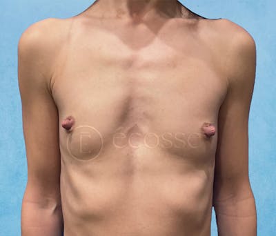 Breast Augmentation Before & After Gallery - Patient 946897 - Image 1