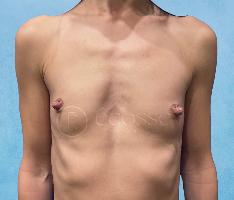 Breast Augmentation Before & After Gallery - Patient 946897 - Image 1