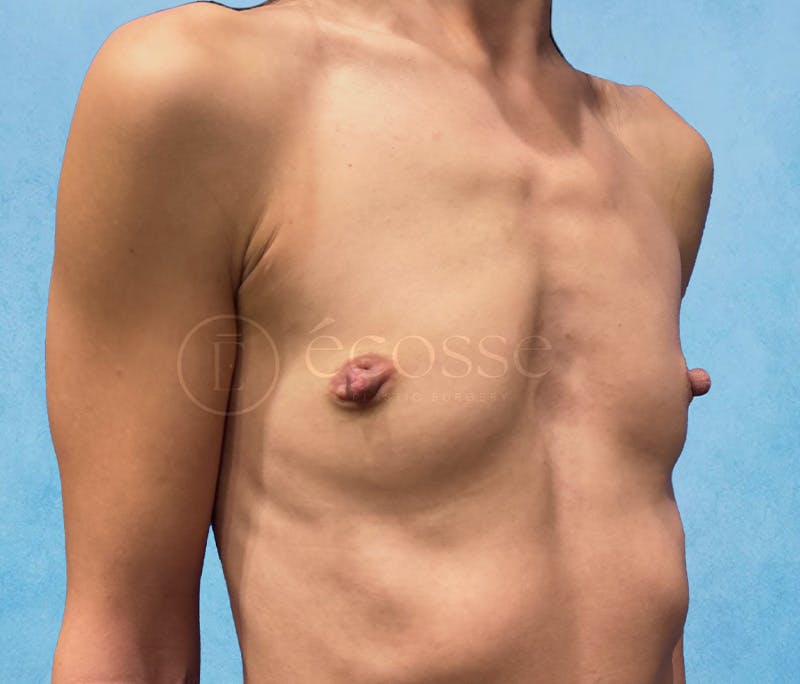 Breast Augmentation Before & After Gallery - Patient 946897 - Image 3