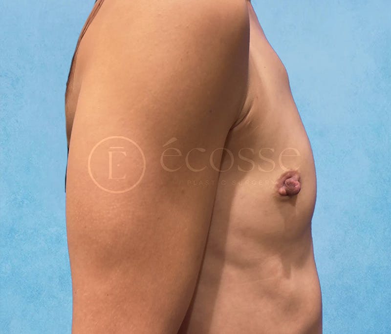 Breast Augmentation Before & After Gallery - Patient 946897 - Image 5