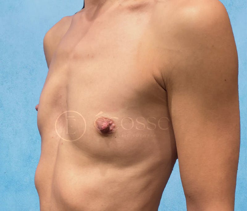 Breast Augmentation Before & After Gallery - Patient 946897 - Image 7