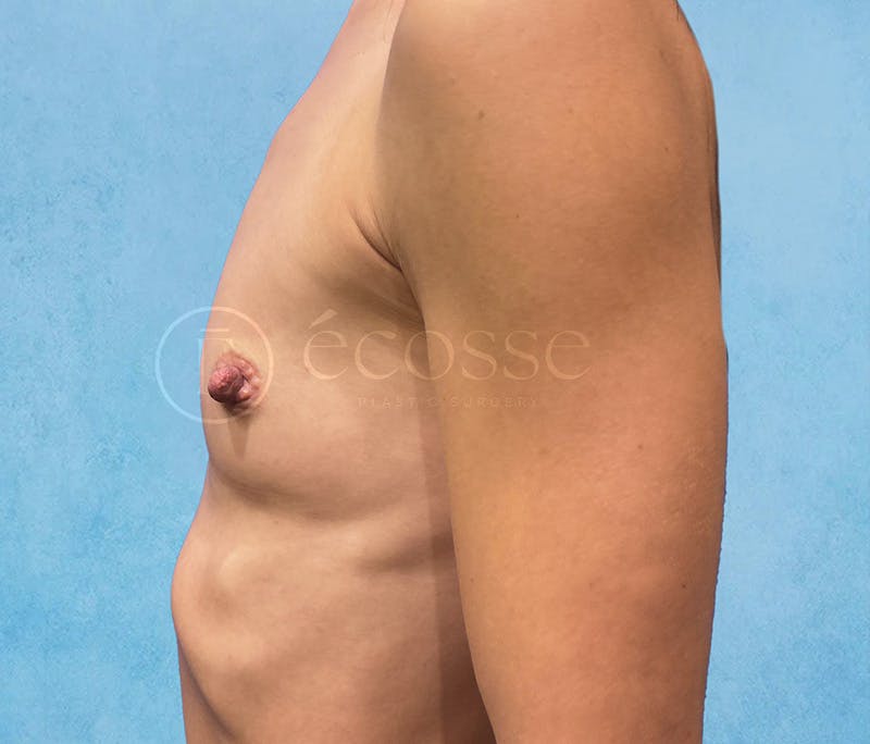 Breast Augmentation Before & After Gallery - Patient 946897 - Image 9