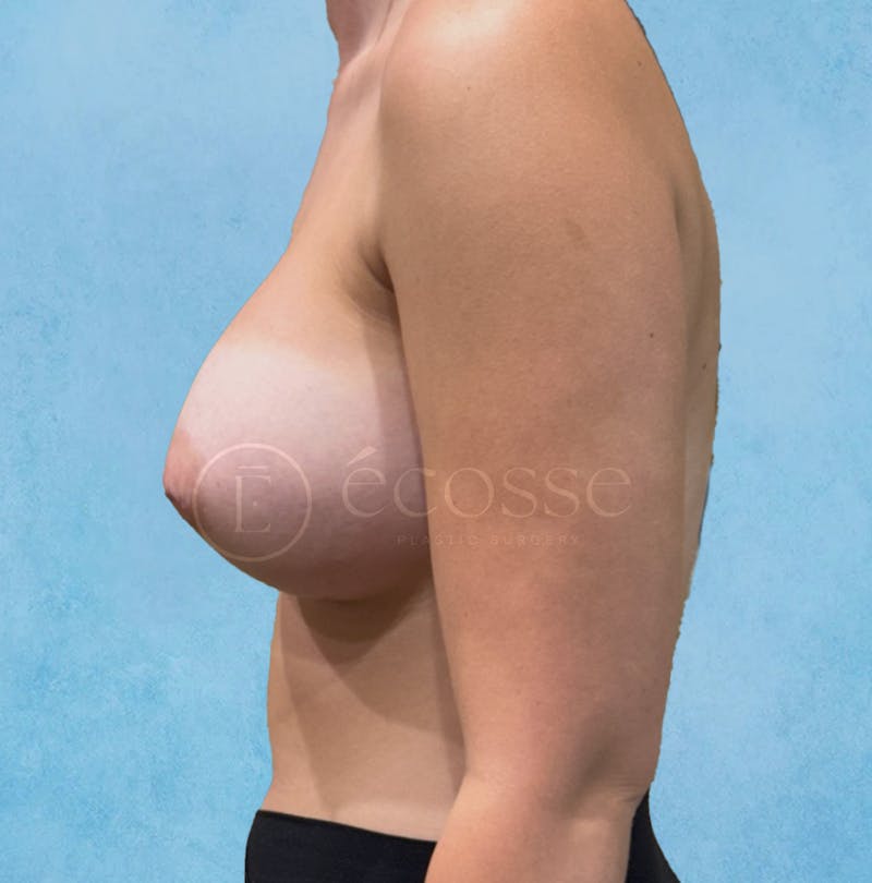 Breast Augmentation Before & After Gallery - Patient 946897 - Image 10