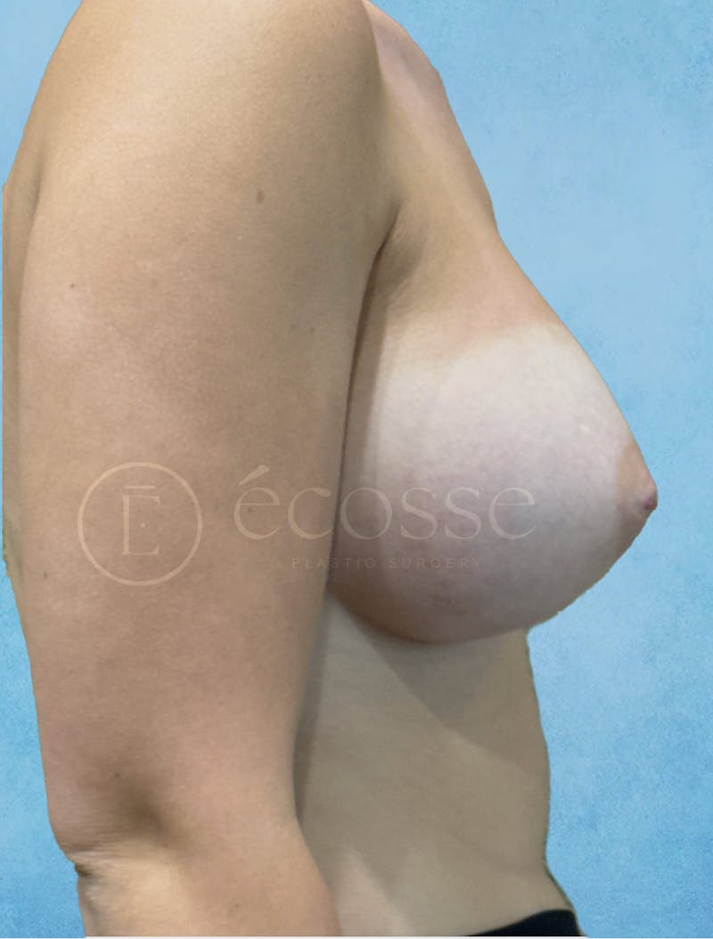 Breast Augmentation Before & After Gallery - Patient 946897 - Image 6