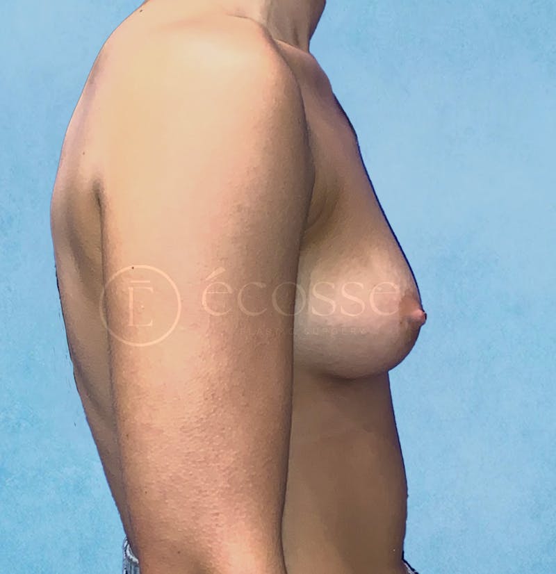 Breast Augmentation Before & After Gallery - Patient 946897 - Image 5