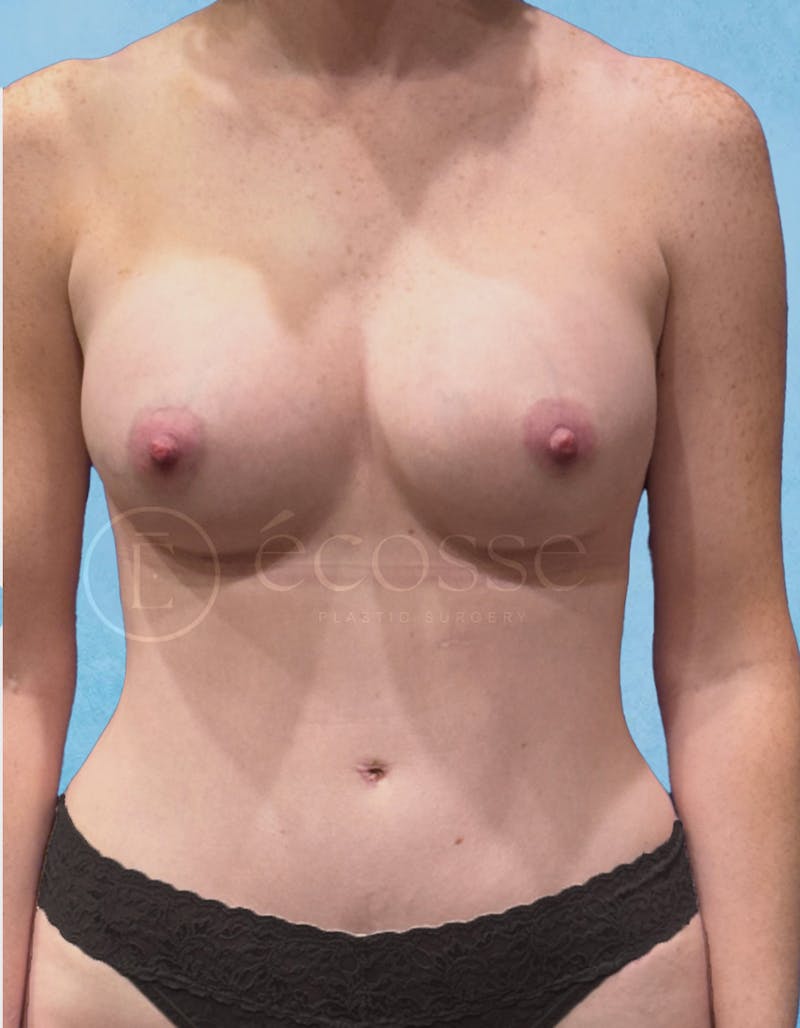 Abdominoplasty Before & After Gallery - Patient 403224 - Image 2