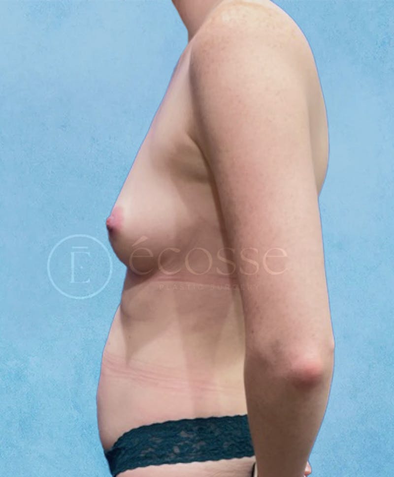 Abdominoplasty Before & After Gallery - Patient 403224 - Image 9