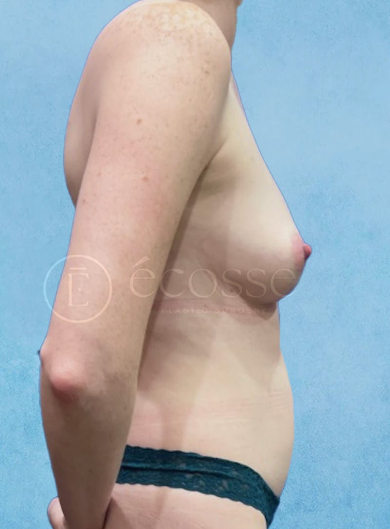 Abdominoplasty Before & After Gallery - Patient 403224 - Image 5