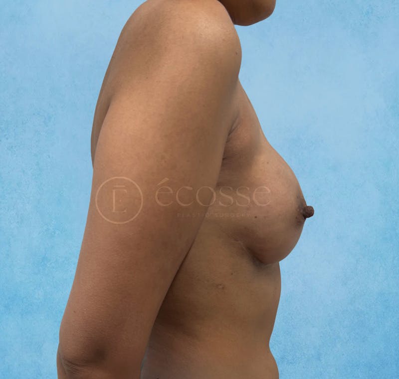 Breast Reconstruction Before & After Gallery - Patient 309456 - Image 6