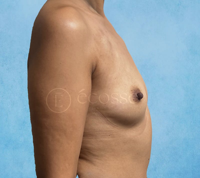 Breast Reconstruction Before & After Gallery - Patient 309456 - Image 5
