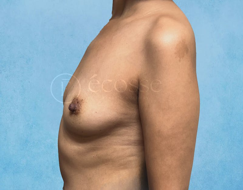 Breast Reconstruction Before & After Gallery - Patient 309456 - Image 9