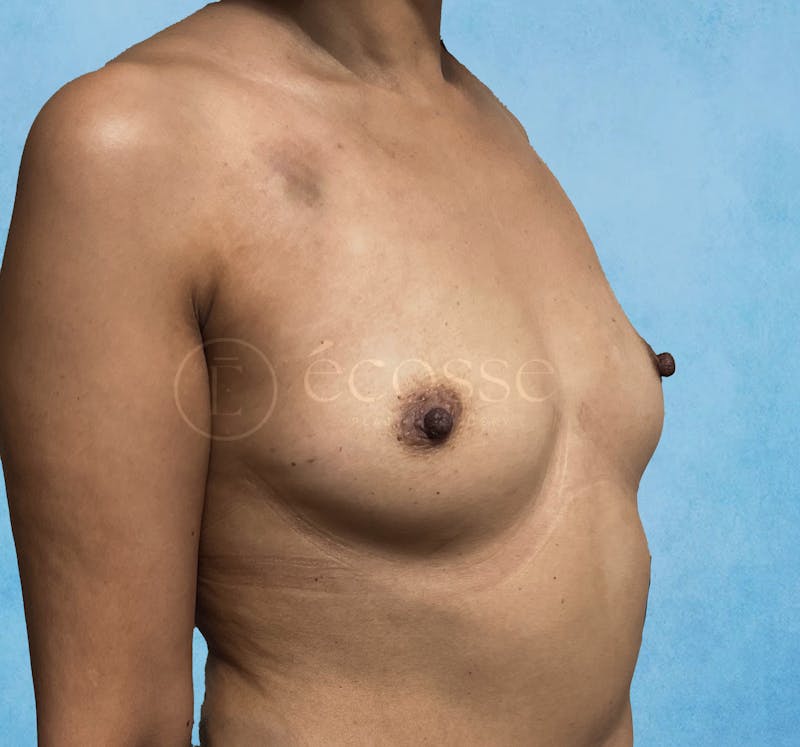 Breast Reconstruction Before & After Gallery - Patient 309456 - Image 3