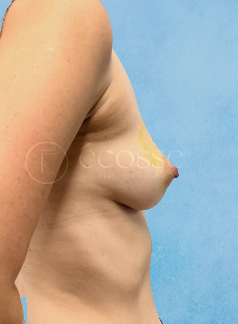 Breast Reconstruction Before & After Gallery - Patient 194490 - Image 5