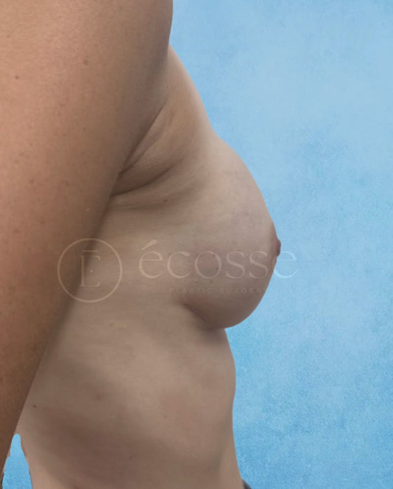 Breast Reconstruction Before & After Gallery - Patient 194490 - Image 6