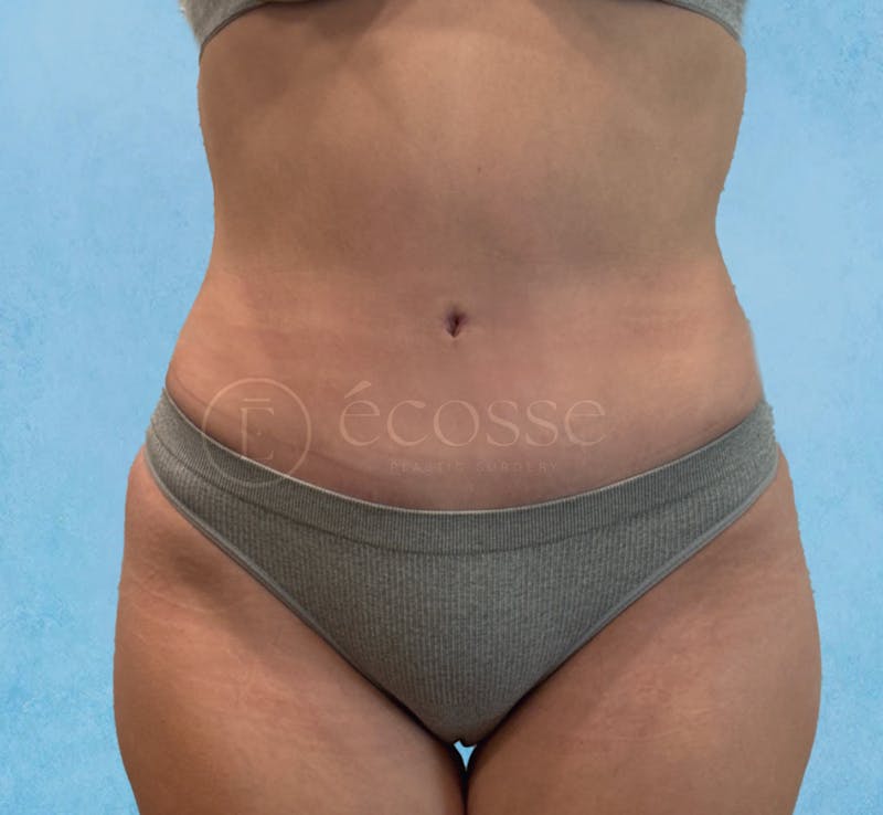 Abdominoplasty Before & After Gallery - Patient 403224 - Image 2
