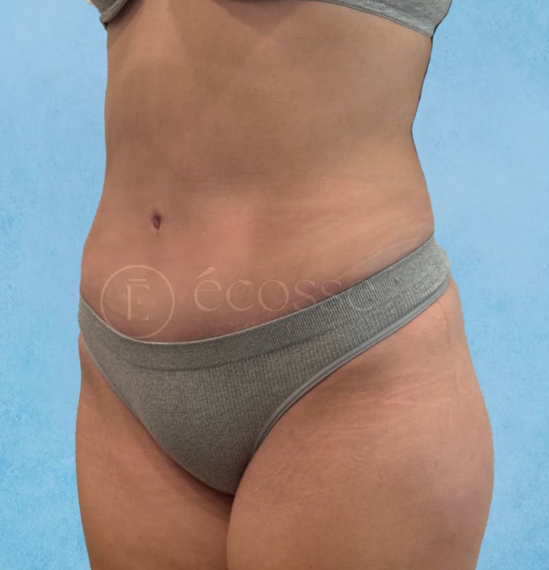 Abdominoplasty Before & After Gallery - Patient 403224 - Image 8