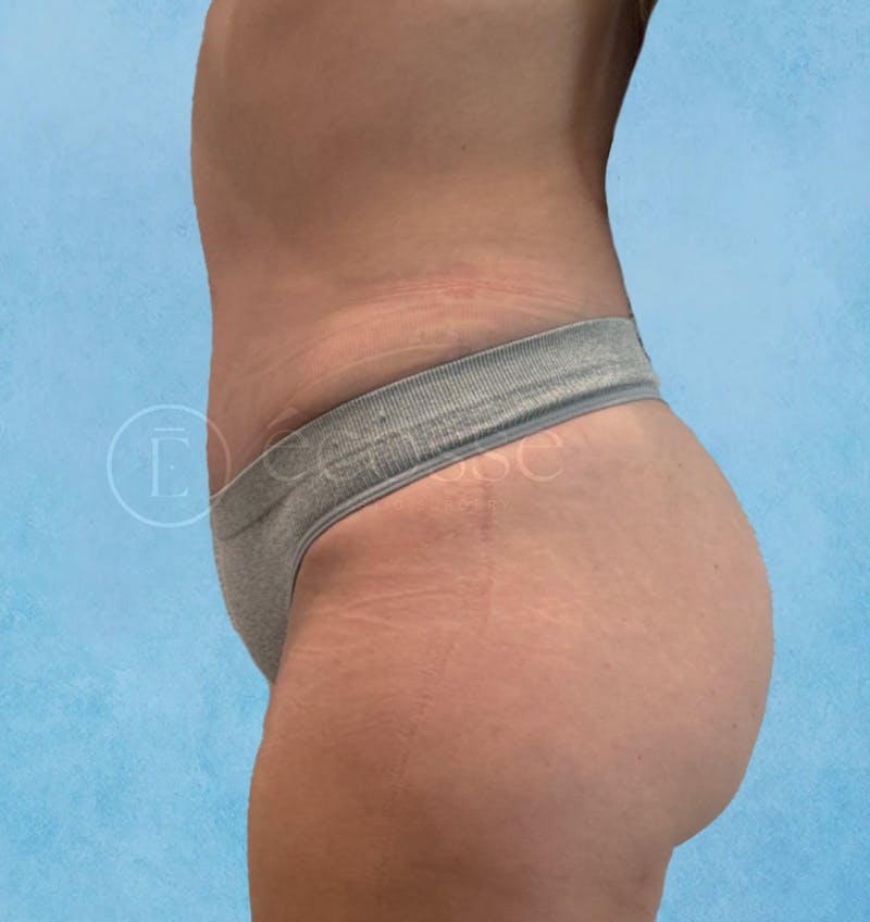 Abdominoplasty Before & After Gallery - Patient 403224 - Image 10