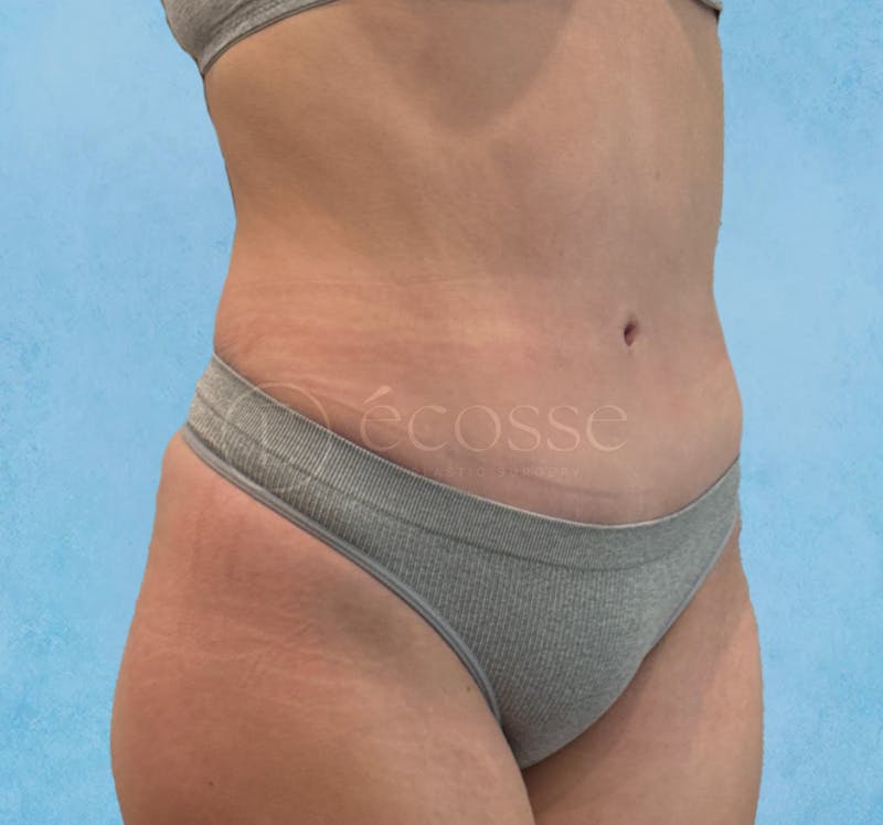 Abdominoplasty Before & After Gallery - Patient 403224 - Image 4