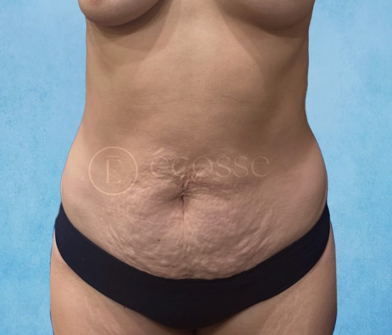 Abdominoplasty Before & After Gallery - Patient 403224 - Image 1