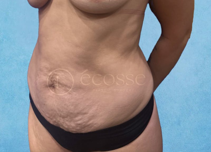Abdominoplasty Before & After Gallery - Patient 403224 - Image 7