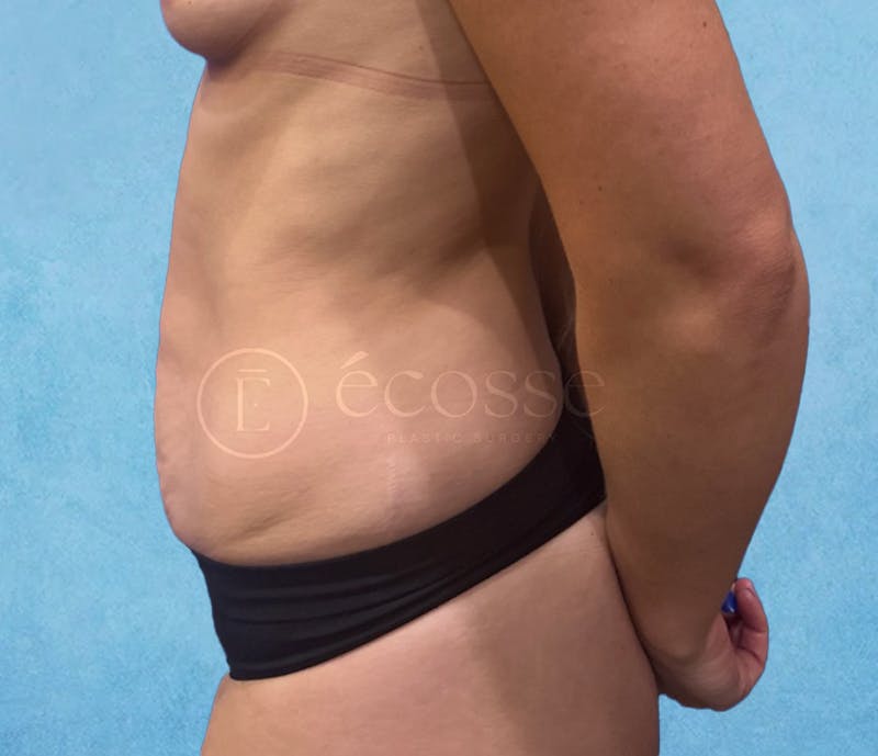 Abdominoplasty Before & After Gallery - Patient 403224 - Image 9