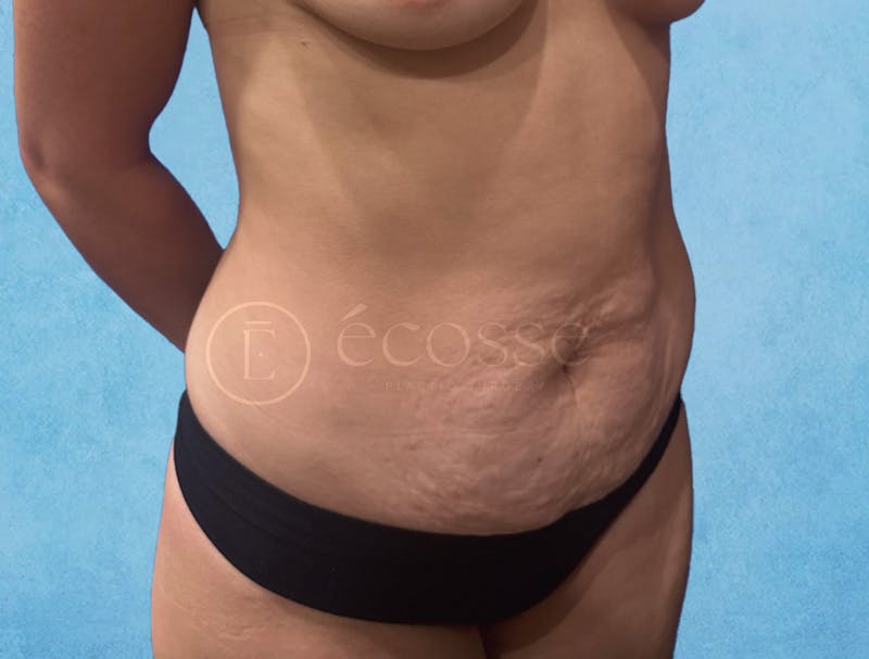 Abdominoplasty Before & After Gallery - Patient 403224 - Image 3