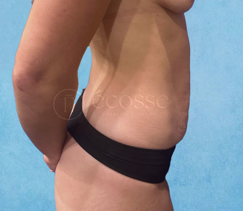 Abdominoplasty Before & After Gallery - Patient 403224 - Image 5