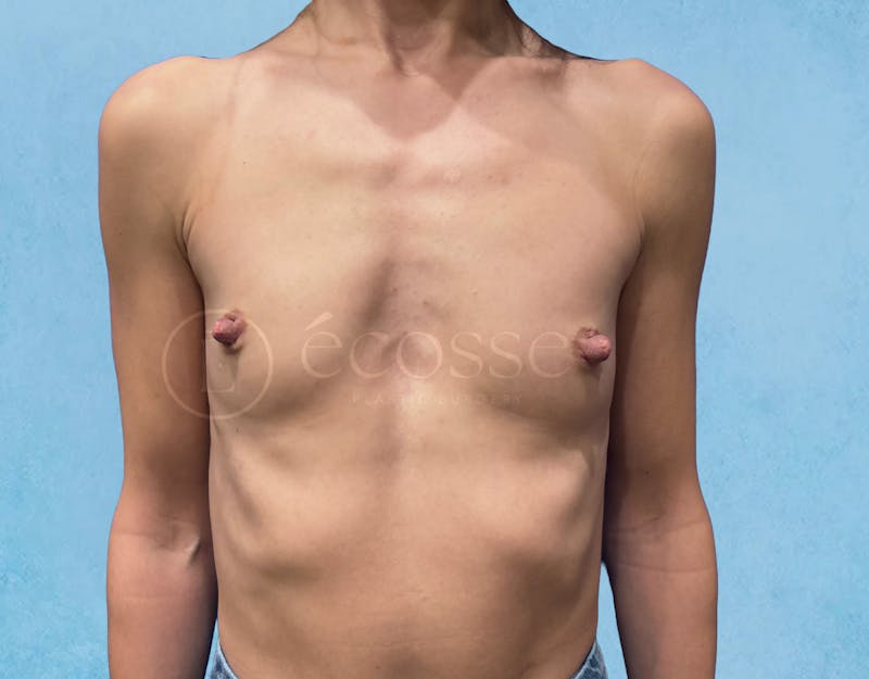 Breast Augmentation Before & After Gallery - Patient 946897 - Image 1