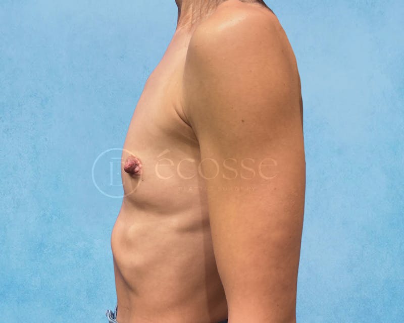 Breast Augmentation Before & After Gallery - Patient 946897 - Image 9