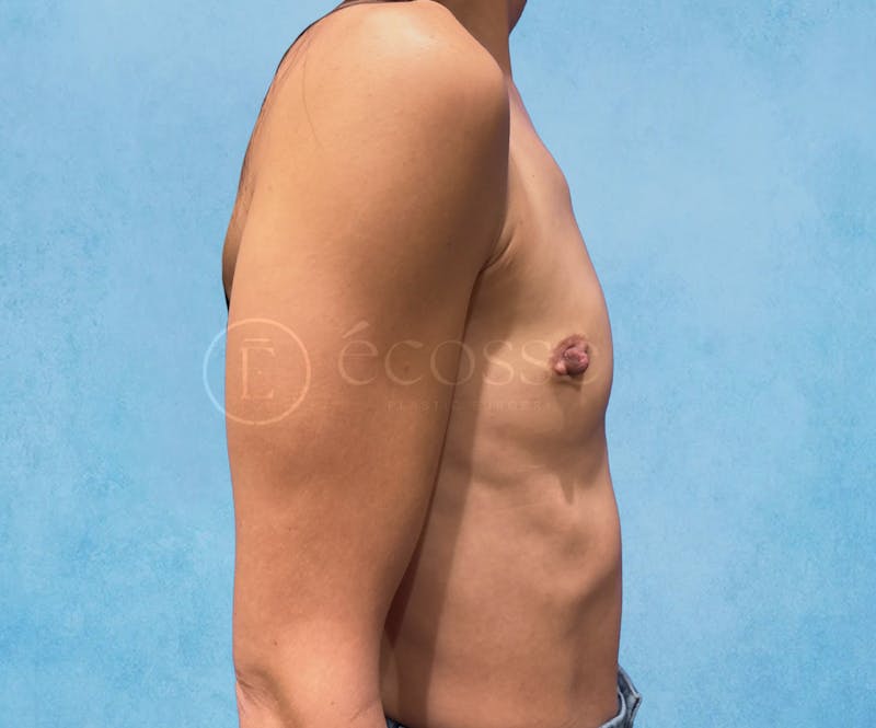 Breast Augmentation Before & After Gallery - Patient 946897 - Image 5