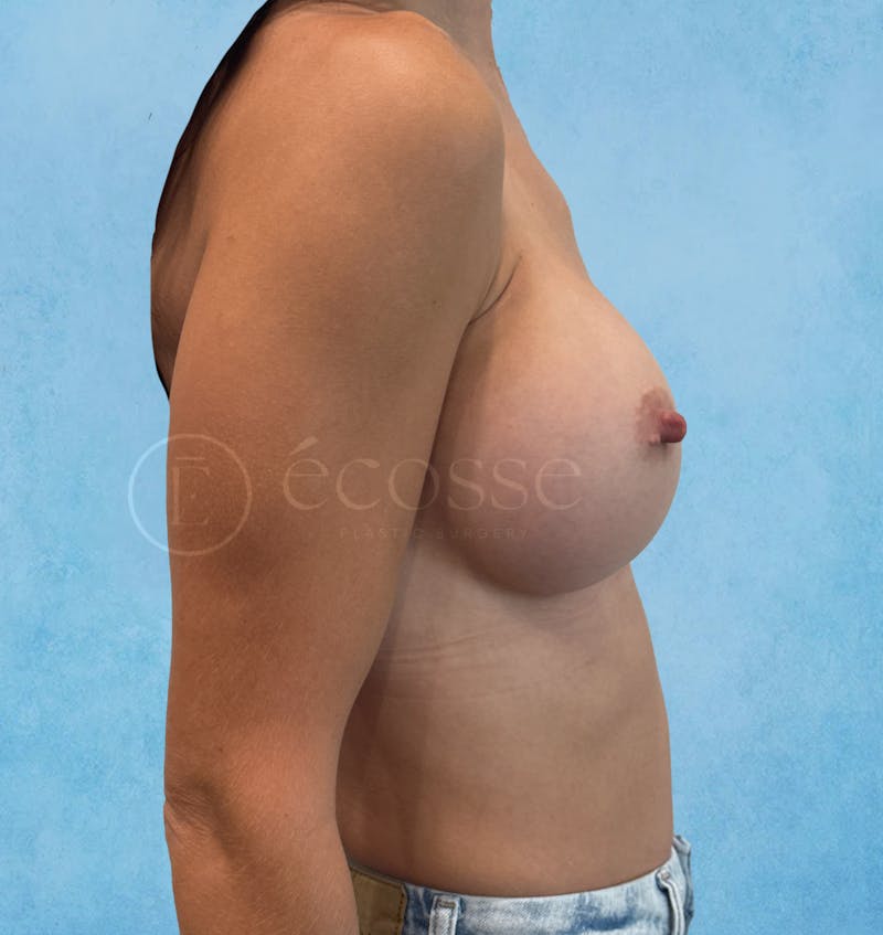 Breast Augmentation Before & After Gallery - Patient 946897 - Image 6