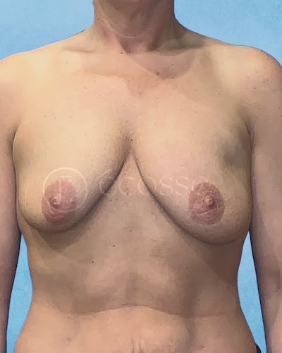 Breast Augmentation Revision Before & After Gallery - Patient 146032 - Image 1