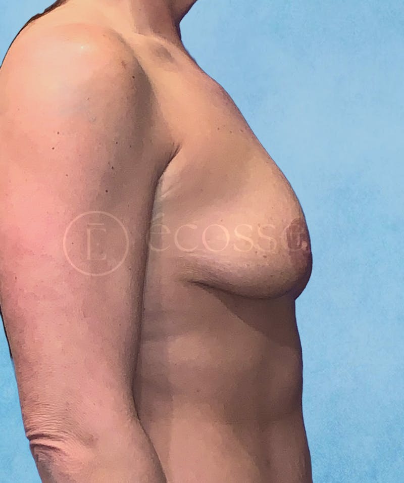 Breast Augmentation Revision Before & After Gallery - Patient 146032 - Image 9