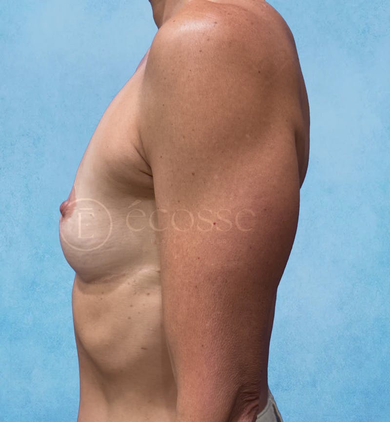 Breast Augmentation Before & After Gallery - Patient 323105 - Image 9